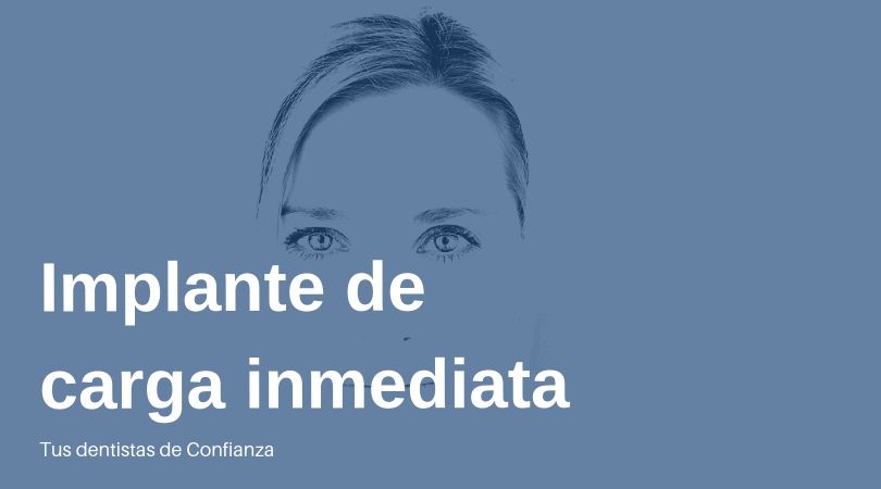 Implantes de Carga Inmediata- Dentistas de Confianza