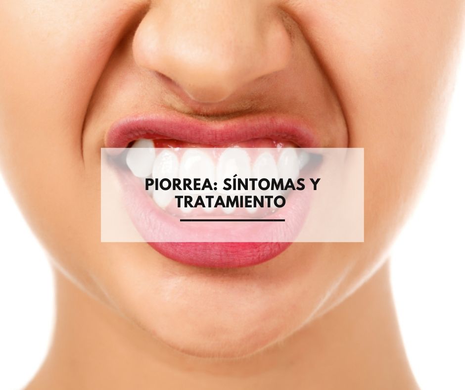 Piorrea: Síntomas y tratamiento
