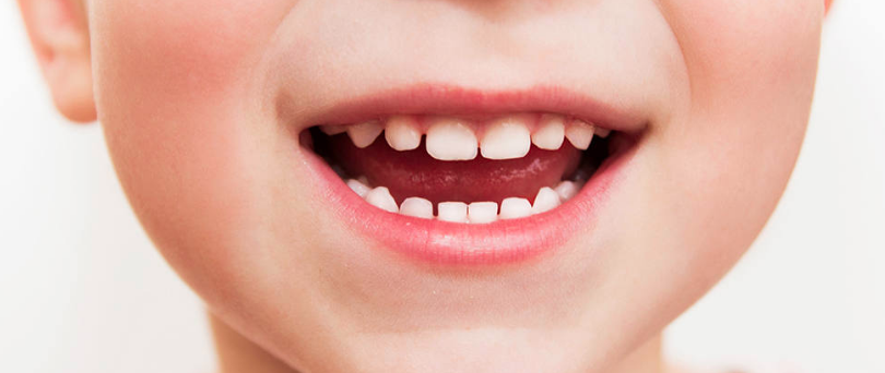 5 señales de que su hijo necesita aparatos de ortodoncia
