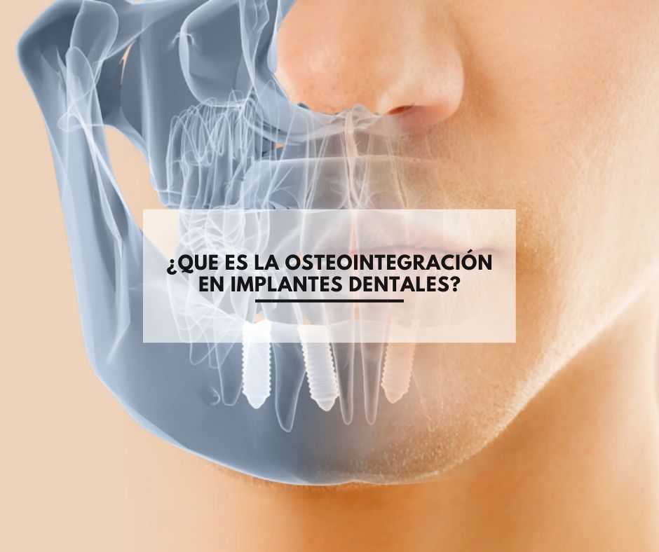 ¿Que es la osteointegración en implantes dentales?